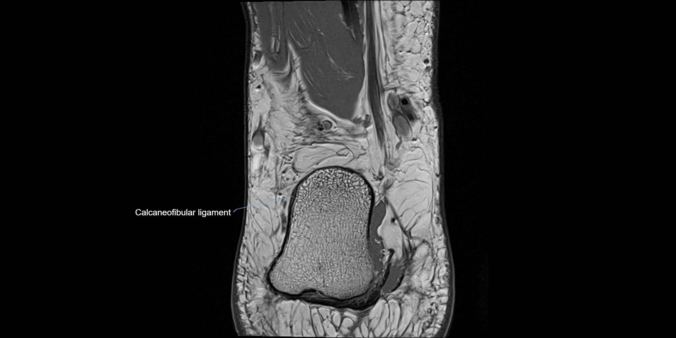 MRI Ankle coronal ligaments cross sectional anatomy 3T  radiology  image-img-00001-00023.webp